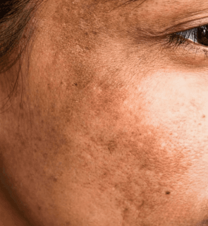 Détail de pigmentation du visage, illustration de la page consacrée au mélasma